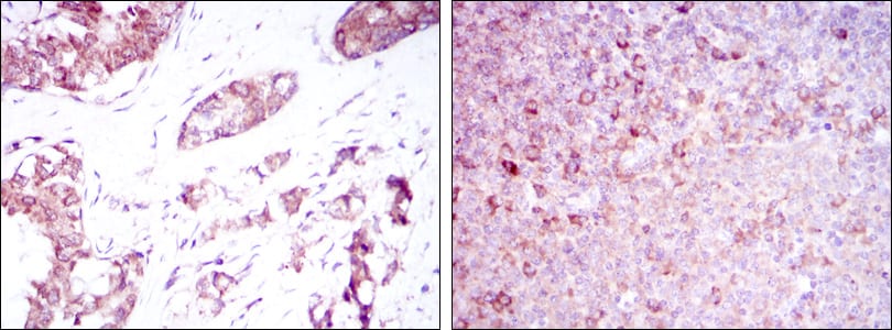 Figure 2: Immunohistochemical analysis of paraffin-embedded breast cancer tissues (left) and tonsil tissues (right) using BMPR2 mouse mAb with DAB staining.