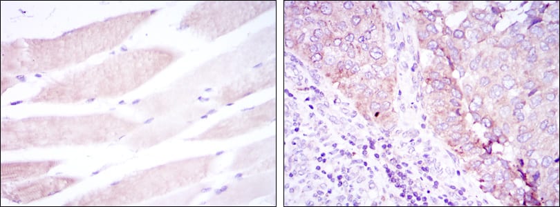 Figure 2: Immunohistochemical analysis of paraffin-embedded muscle tissues (left) and kidney cancer tissues (right) using BMPR2 mouse mAb with DAB staining.