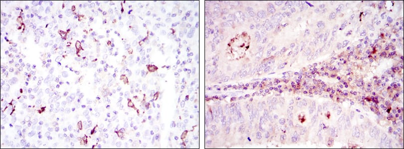 Figure 2: Immunohistochemical analysis of paraffin-embedded cervical cancer tissues (left) and colon cancer tissues (right) using CD1A mouse mAb with DAB staining.