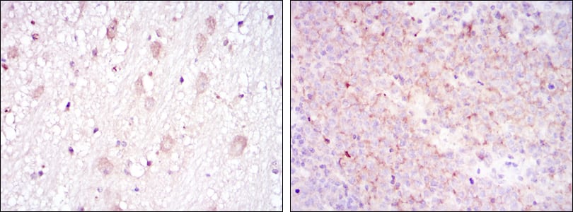 Figure 3: Immunohistochemical analysis of paraffin-embedded brain tissues (left) and submaxillary tumor tissues (right) using CD1A mouse mAb with DAB staining.