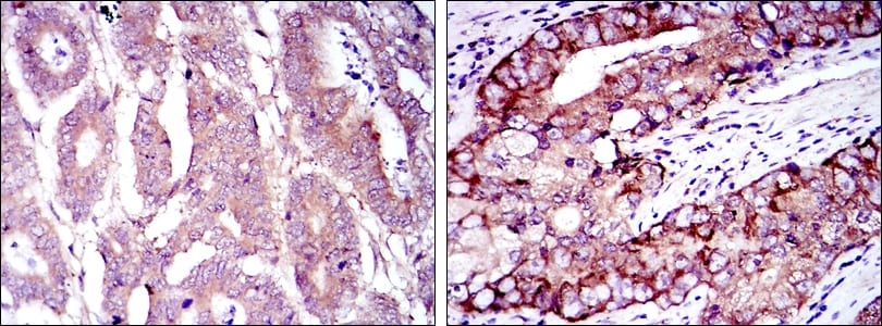 Figure 3: Immunohistochemical analysis of paraffin-embedded stomach cancer (left) and prostate cancer (right) using EIF4E mouse mAb with DAB staining.