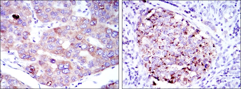 Figure 2: Immunohistochemical analysis of paraffin-embedded liver cancer tissues (left) and kidney cancer tissues (right) using EEF2 mouse mAb with DAB staining.