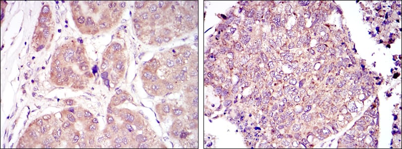 Figure 2: Immunohistochemical analysis of paraffin-embedded liver cancer tissues (left) and lung cancer tissues (right) using HIF1A mouse mAb with DAB staining.