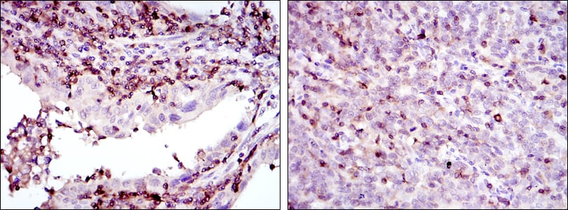 Figure 2: Immunohistochemical analysis of paraffin-embedded endometrial cancer tissues (left) and cervical cancer tissues (right) using GRK2 mouse mAb with DAB staining.