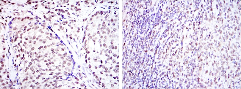 Figure 2: Immunohistochemical analysis of paraffin-embedded prostate cancer tissues (left) and submaxillary tumor tissues (right) using CREB1 mouse mAb with DAB staining.