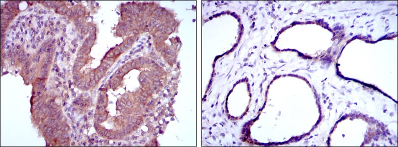 Figure 4: Immunohistochemical analysis of paraffin-embedded intima cancer tissues (left) and prostate tissues (right) using MTHFR mouse mAb with DAB staining.