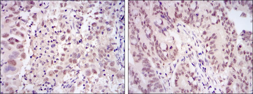 Figure 2: Immunohistochemical analysis of paraffin-embedded endometrial cancer tissues (left) and rectum cancer tissues (right) using CDK9 mouse mAb with DAB staining.