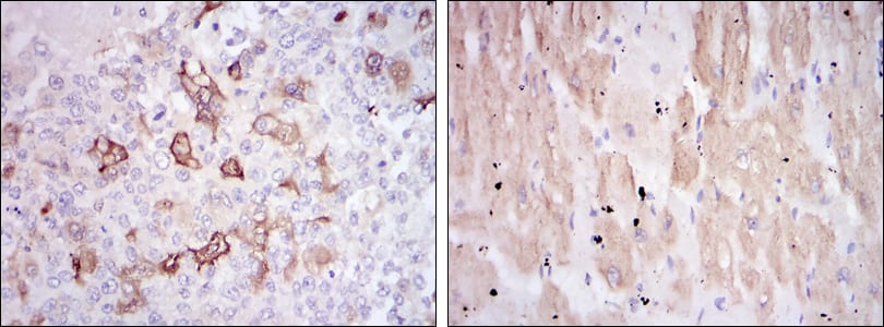 Figure 3: Immunohistochemical analysis of paraffin-embedded breast cancer tissues (left) and cardiac muscle tissues (right) using HSP27 mouse mAb with DAB staining.