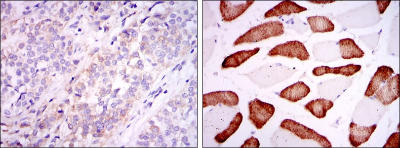 Figure 2: Immunohistochemical analysis of paraffin-embedded bladder cancer tissues (left) and skeletal muscle tissues (right) using ABCG2 mouse mAb with DAB staining.