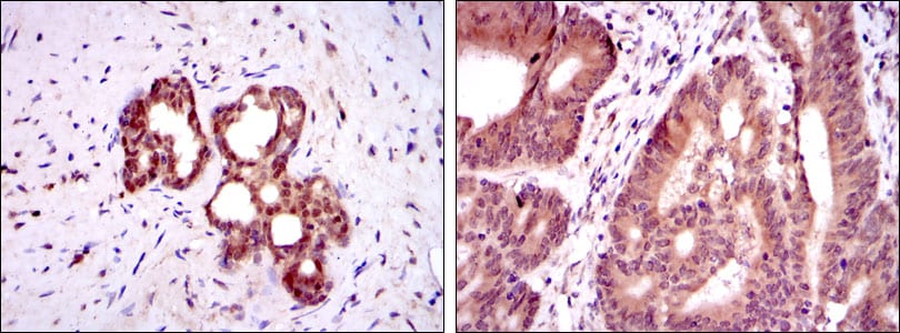 Figure 3: Immunohistochemical analysis of paraffin-embedded prostate tissues (left) and colon cancer tissues (right) using OTX2 mouse mAb with DAB staining.