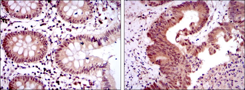 Figure 3: Immunohistochemical analysis of paraffin-embedded colon tissues (left) and colon cancer tissues (right) using OTX2 mouse mAb with DAB staining.