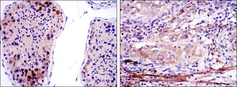 Figure 2: Immunohistochemical analysis of paraffin-embedded testis tissues (left) and lung cancer tissues (right) using SMN1 mouse mAb with DAB staining.