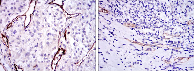 Figure 2: Immunohistochemical analysis of paraffin-embedded kidney cancer tissues (left) and stomach cancer tissues (right) using CD105 mouse mAb with DAB staining.