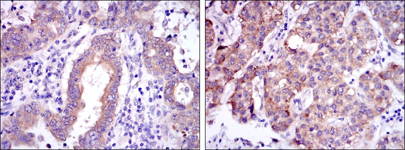 Figure 2: Immunohistochemical analysis of paraffin-embedded endometrial cancer tissues (left) and liver cancer tissues (right) using c-Rel mouse mAb with DAB staining.