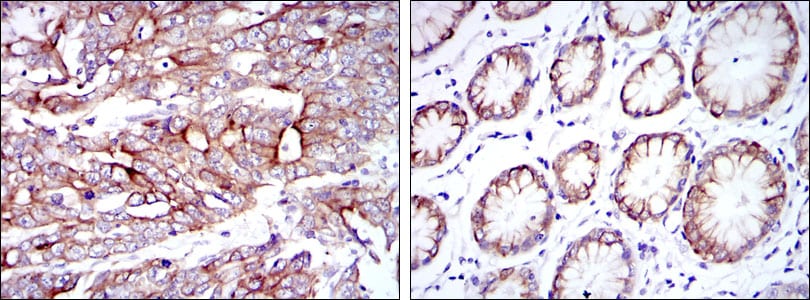 Figure 3: Immunohistochemical analysis of paraffin-embedded stomach cancer tissues (left) and stomach tissues (right) using KRT19 mouse mAb with DAB staining.