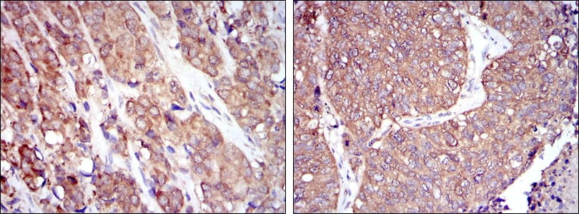 Figure 2: Immunohistochemical analysis of paraffin-embedded prostate cancer tissues (left) and lung cancer tissues (right) using HSP90AB1 mouse mAb with DAB staining.