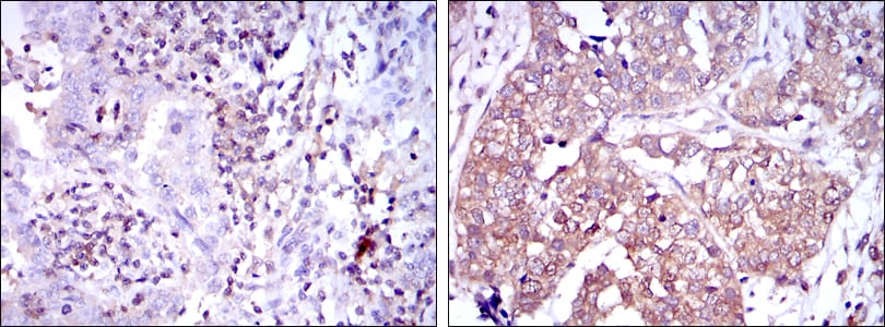 Figure 2: Immunohistochemical analysis of paraffin-embedded human intima cancer tissues (left) and human bladder cancer tissues (right) using NFKB1 mouse mAb with DAB staining.