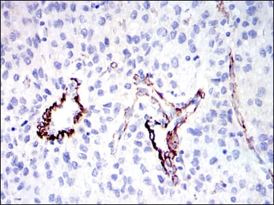 Figure 2: Immunohistochemical analysis of paraffin-embedded human liver cancer tissues using GKAP mouse mAb with DAB staining.