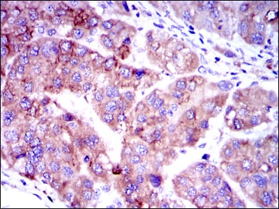 Figure 3: Immunohistochemical analysis of paraffin-embedded human liver cancer tissues using SMAD2 mouse mAb with DAB staining.