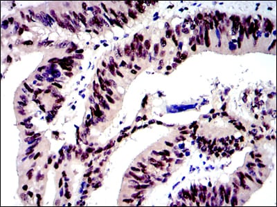 Figure 4: Immunohistochemical analysis of paraffin-embedded human rectum cancer tissues using c-Jun mouse mAb with DAB staining.