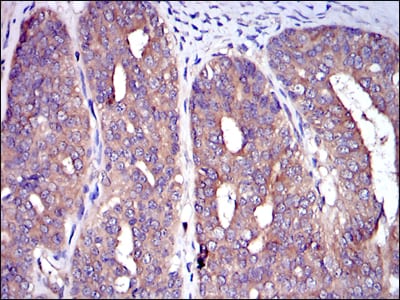 Figure 3: Immunohistochemical analysis of paraffin-embedded ovarian cancer tissues using C-CBL mouse mAb with DAB staining.