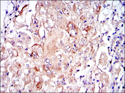 Figure 4: Immunohistochemical analysis of paraffin-embedded lung cancer tissues using PRK2 mouse mAb with DAB staining.