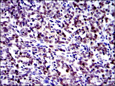 Figure 3: Immunohistochemical analysis of paraffin-embedded cervical cancer tissues using c-Jun mouse mAb with DAB staining.