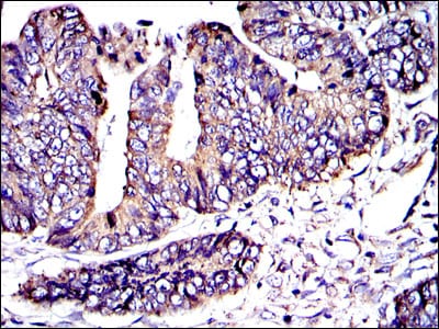 Figure 3: Immunohistochemical analysis of paraffin-embedded rectum cancer tissues using CRK mouse mAb with DAB staining.