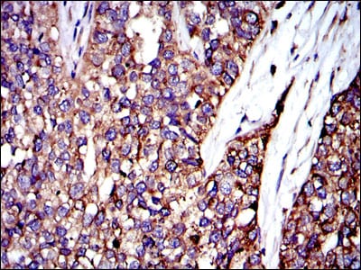 Figure 4: Immunohistochemical analysis of paraffin-embedded bladder cancer tissues using CRK mouse mAb with DAB staining.