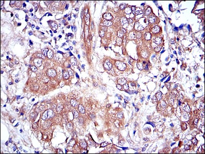 Figure 3: Immunohistochemical analysis of paraffin-embedded breast cancer tissues using MAPK3 mouse mAb with DAB staining.