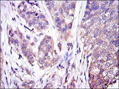 Figure 4: Immunohistochemical analysis of paraffin-embedded bladder cancer tissues using MAPK3 mouse mAb with DAB staining.