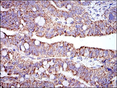 Figure 3: Immunohistochemical analysis of paraffin-embedded rectum cancer tissues using PHB mouse mAb with DAB staining.