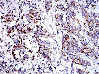 Figure 6: Immunohistochemical analysis of paraffin-embedded stomach cancer tissues using PHB mouse mAb with DAB staining.