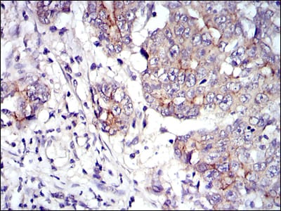 Figure 4: Immunohistochemical analysis of paraffin-embedded stomach cancer tissues using JUP mouse mAb with DAB staining.