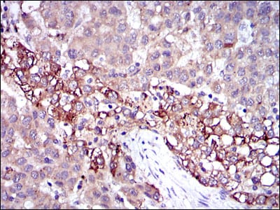 Figure 3: Immunohistochemical analysis of paraffin-embedded liver cancer tissues using FGG mouse mAb with DAB staining.