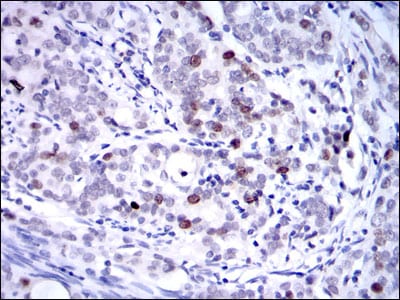 Figure 3: Immunohistochemical analysis of paraffin-embedded cervical cancer tissues using KID mouse mAb with DAB staining.