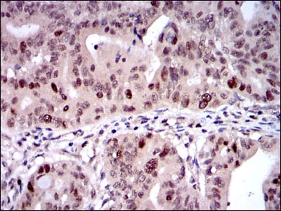 Figure 3: Immunohistochemical analysis of paraffin-embedded rectum cancer tissues using KID mouse mAb with DAB staining.