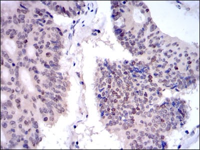 Figure 4: Immunohistochemical analysis of paraffin-embedded colon cancer tissues using KID mouse mAb with DAB staining.