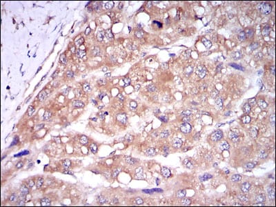 Figure 3: Immunohistochemical analysis of paraffin-embedded liver cancer tissues using CASP8 mouse mAb with DAB staining.