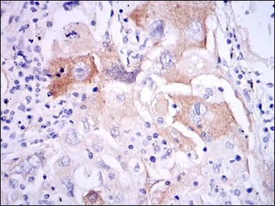 Figure 4: Immunohistochemical analysis of paraffin-embedded lung cancer tissues using IL1B mouse mAb with DAB staining.