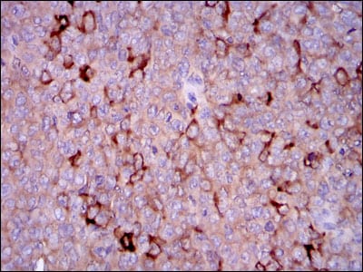 Figure 3: Immunohistochemical analysis of paraffin-embedded ovarian cancer tissues using G6PD mouse mAb with DAB staining.