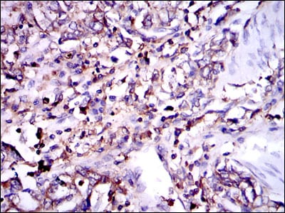 Figure 4: Immunohistochemical analysis of paraffin-embedded stomach cancer tissues using G6PD mouse mAb with DAB staining.