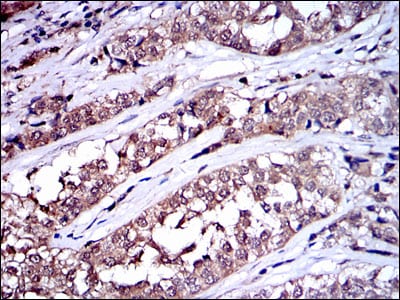 Figure 3: Immunohistochemical analysis of paraffin-embedded bladder cancer tissues using SRC mouse mAb with DAB staining.