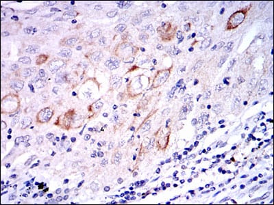 Figure 2: Immunohistochemical analysis of paraffin-embedded lung cancer tissues using MAP2K7 mouse mAb with DAB staining.