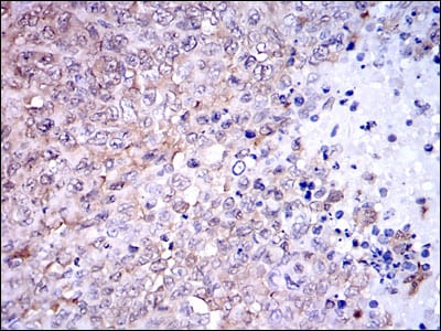 Figure 4: Immunohistochemical analysis of paraffin-embedded ovarian cancer tissues using NQO1 mouse mAb with DAB staining.