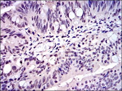 Figure 3: Immunohistochemical analysis of paraffin-embedded rectum cancer tissues using SKP1 mouse mAb with DAB staining.