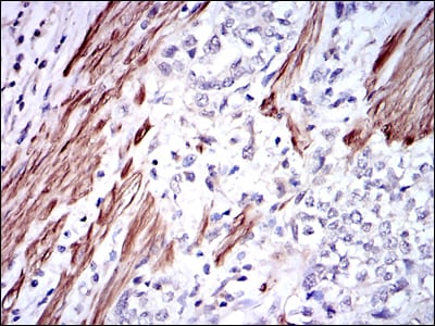 Figure 3: Immunohistochemical analysis of paraffin-embedded rectum cancer tissues using GSTM1 mouse mAb with DAB staining.