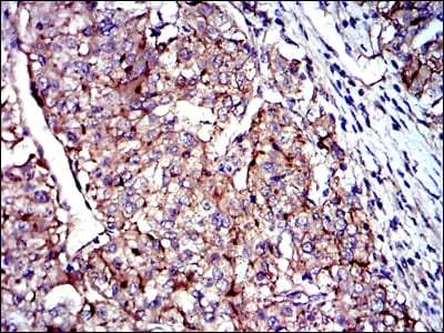 Figure 3: Immunohistochemical analysis of paraffin-embedded kidney cancer tissues using CD9 mouse mAb with DAB staining.