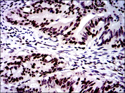 Figure 4: Immunohistochemical analysis of paraffin-embedded rectum cancer tissues using MSH6 mouse mAb with DAB staining.