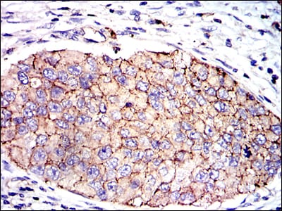 Figure 4: Immunohistochemical analysis of paraffin-embedded kidney cancer tissues using SERPINE1 mouse mAb with DAB staining.